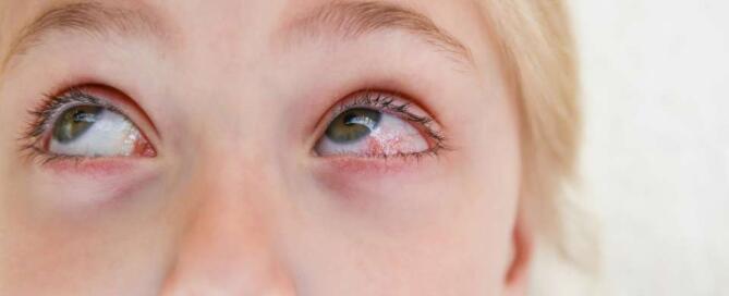 What Is Conjunctivitis Symptoms And Treatment